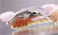 歯ぐきの健康と噛み心地を考えた入れ歯の新技術「コンフォート」